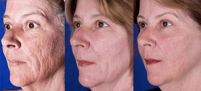 النتيجة بعد إجراء عملية تجديد بشرة الوجه بالليزر